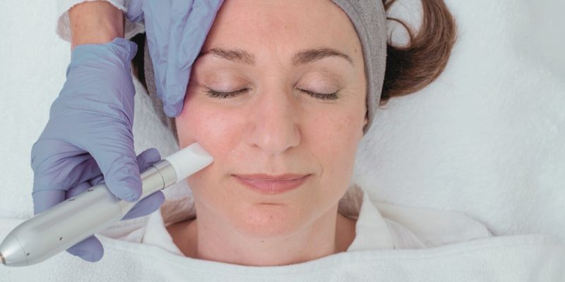 Kundin bei Microneedling-Behandlung in Stuttgart